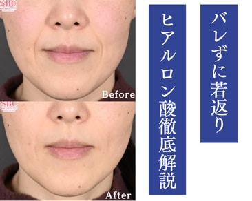 【ほうれい線サヨナラ✨】山形院で「初めてのヒアルロン酸」デビュー💉